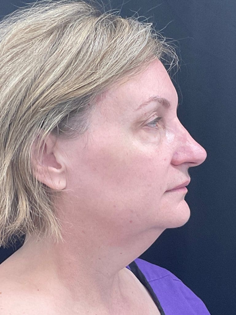 Face & Neck Lift - Case 462 - Before