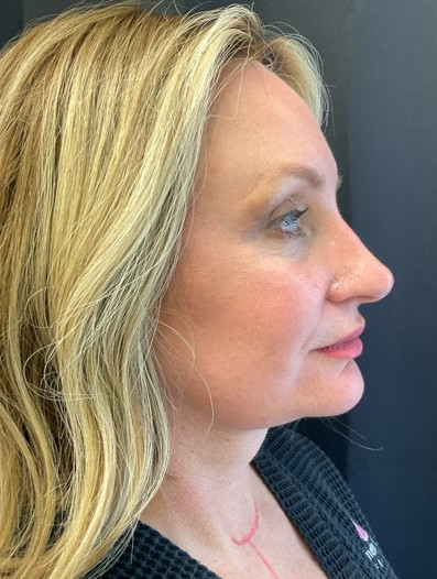 Face & Neck Lift - Case 462 - After