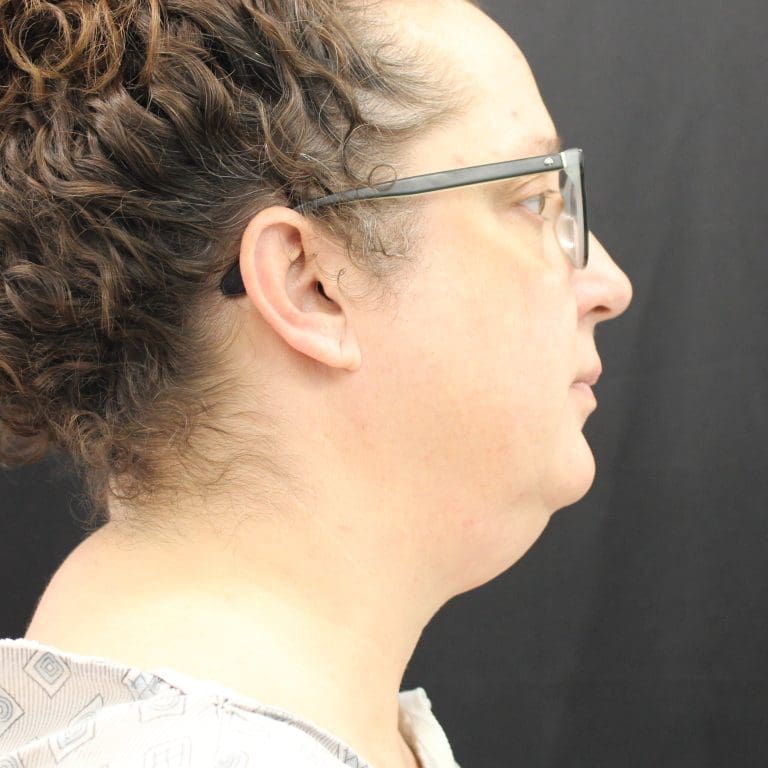 Face & Neck Lift - Case 460 - Before