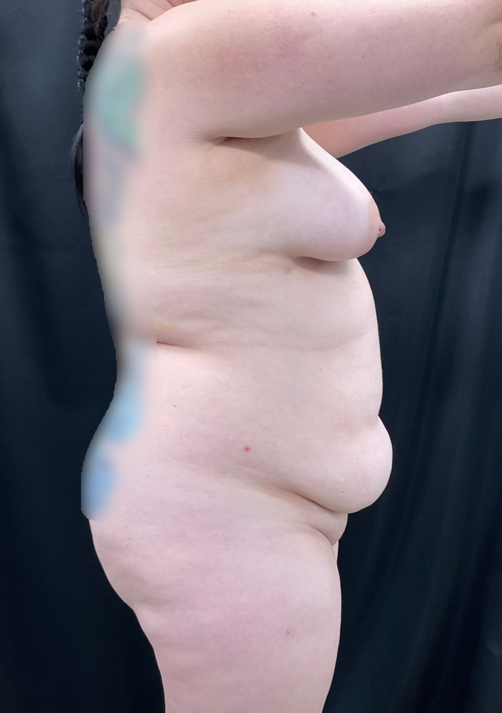 Breast Augmentation/Lift Patient Photo - Case 588 - before view-1