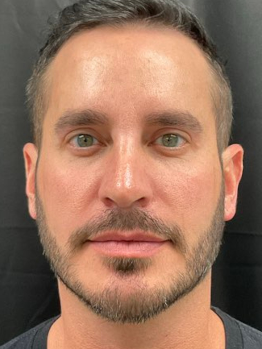 Eyelid Surgery Patient Photo - Case 632 - after view