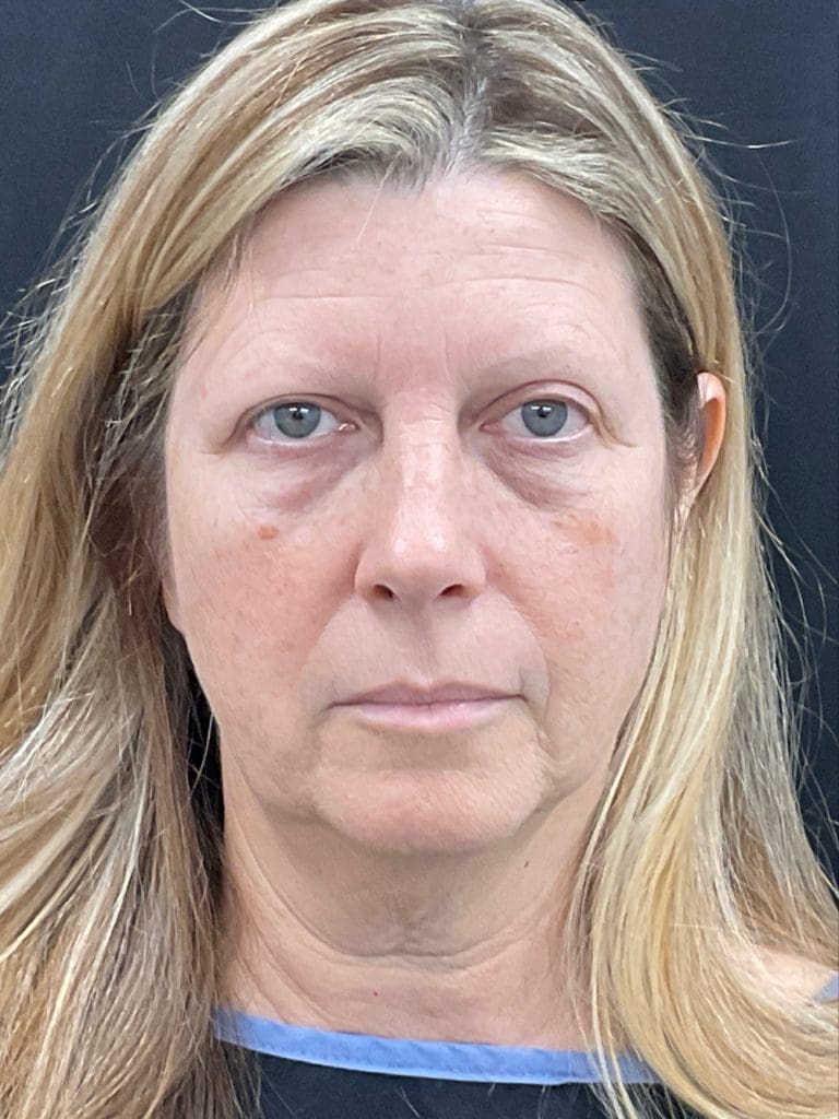 Face & Neck Lift - Case 459 - Before