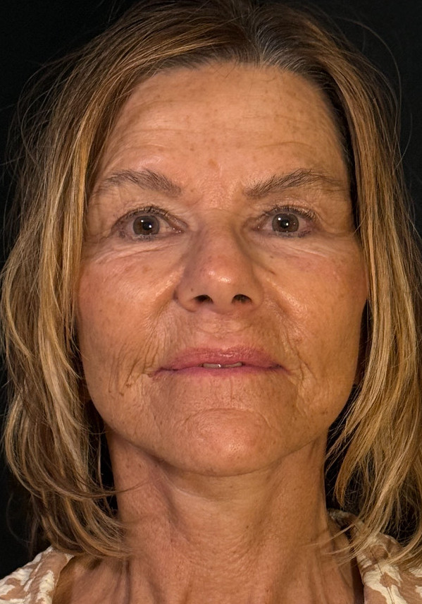 Face & Neck Lift Patient Photo - Case 773 - after view-1