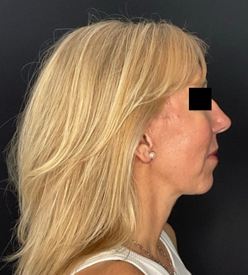 Face & Neck Lift Patient Photo - Case 826 - after view-4