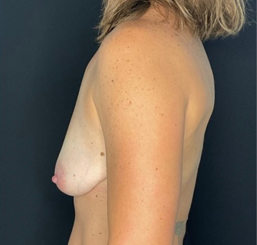Breast Augmentation/Lift Patient Photo - Case 864 - before view-2