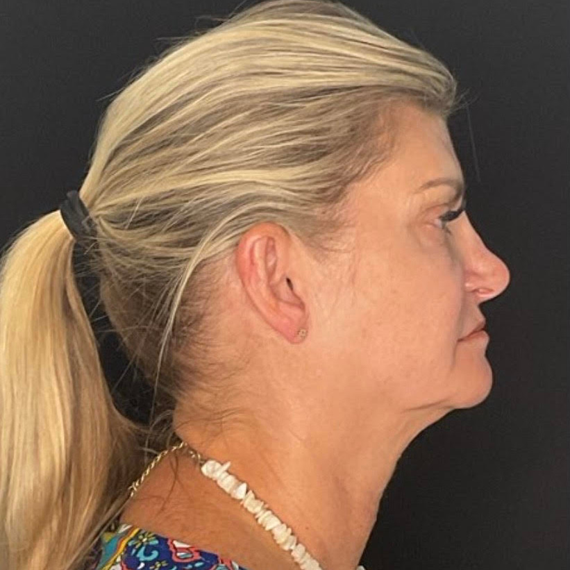 Face & Neck Lift Patient Photo - Case 878 - before view-4