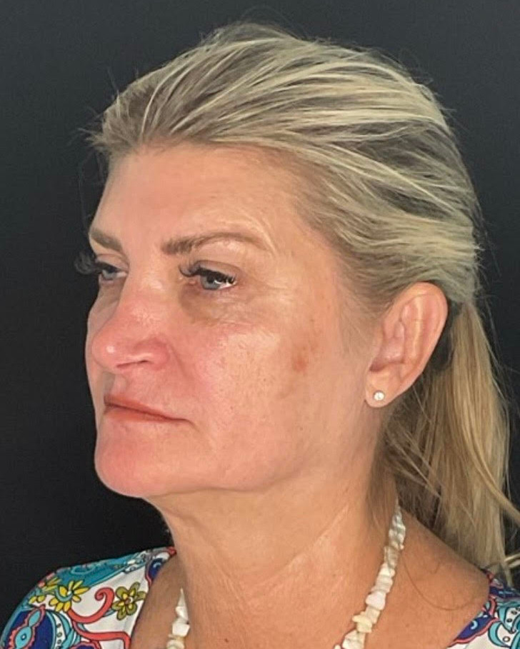 Face & Neck Lift Patient Photo - Case 878 - before view-2