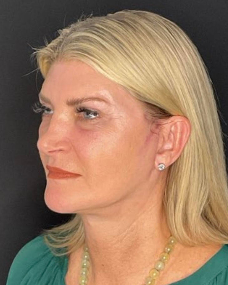 Face & Neck Lift Patient Photo - Case 878 - after view-2