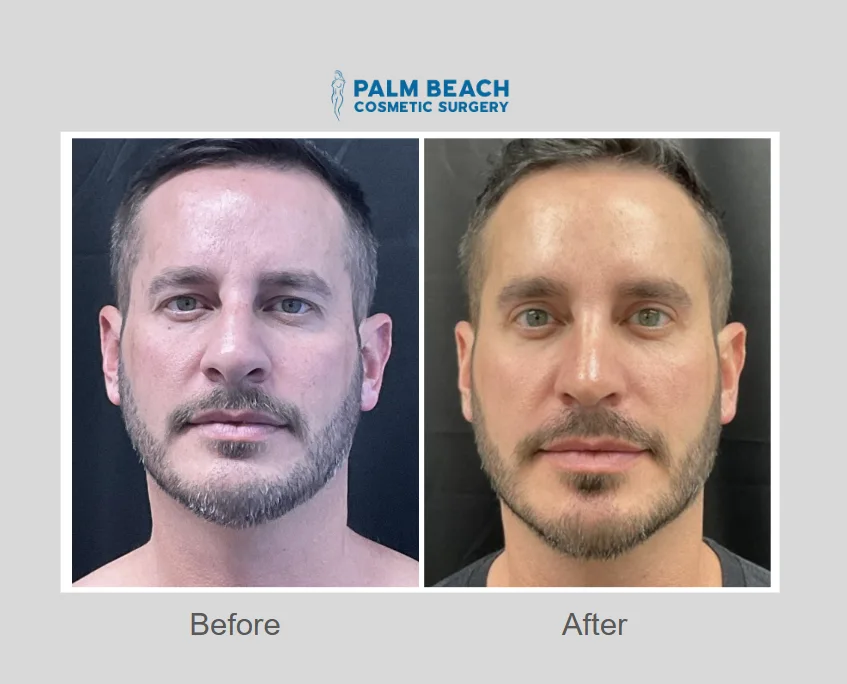 What are the different types of blepharoplasty results shown in photo galleries?