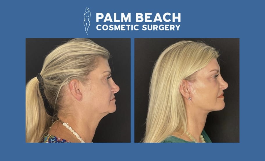 Neck Lift Before and After: A Realistic Look at Patient Results