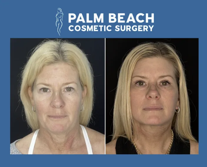 Should you combine a neck lift with other facial procedures?