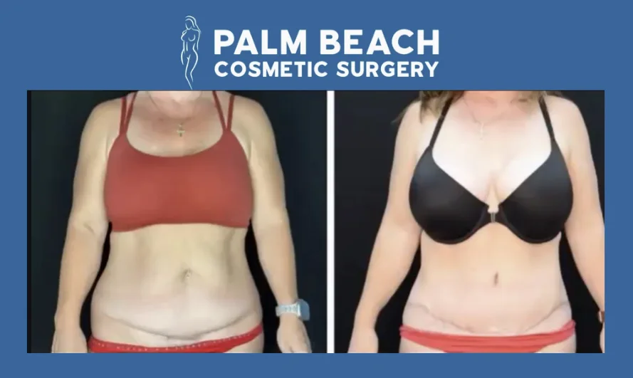 Tummy Tuck Results Over Time: What Lasts and What Changes