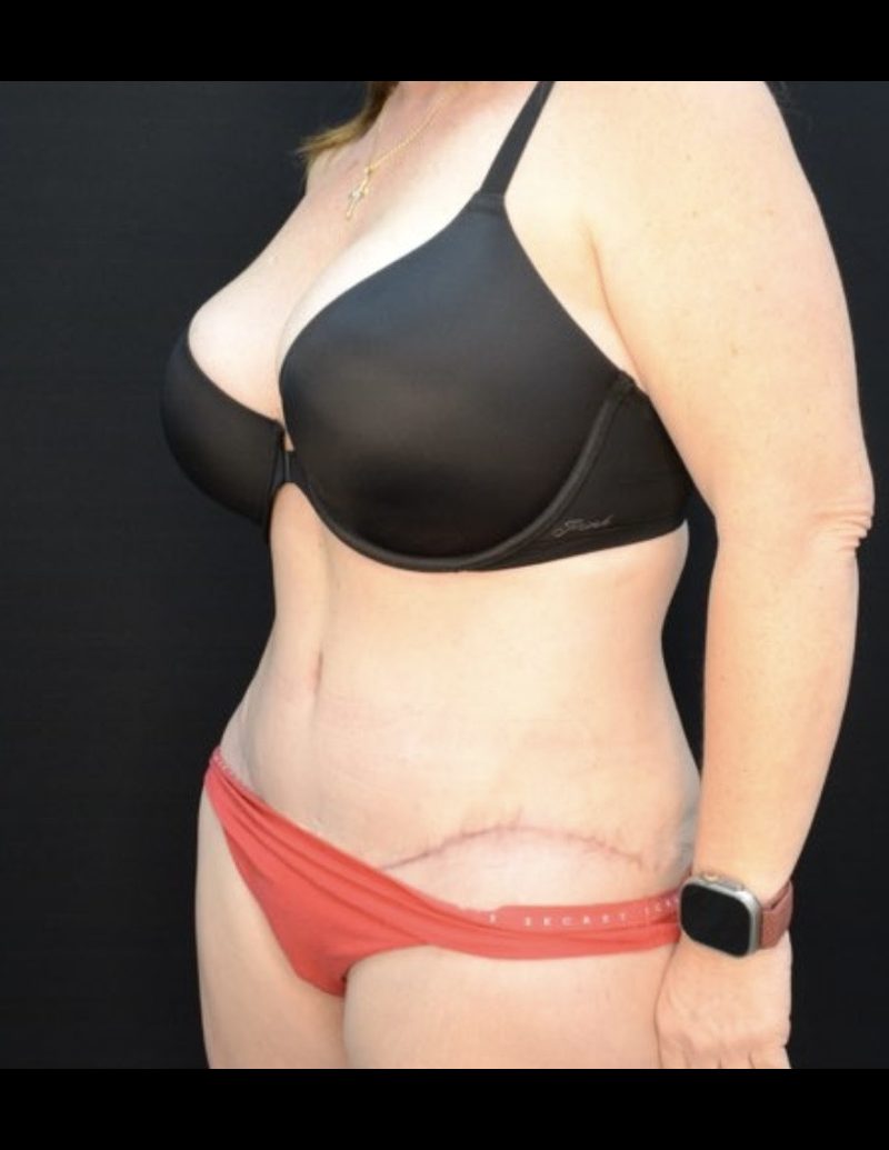 Tummy Tuck Patient Photo - Case 605 - after view-1