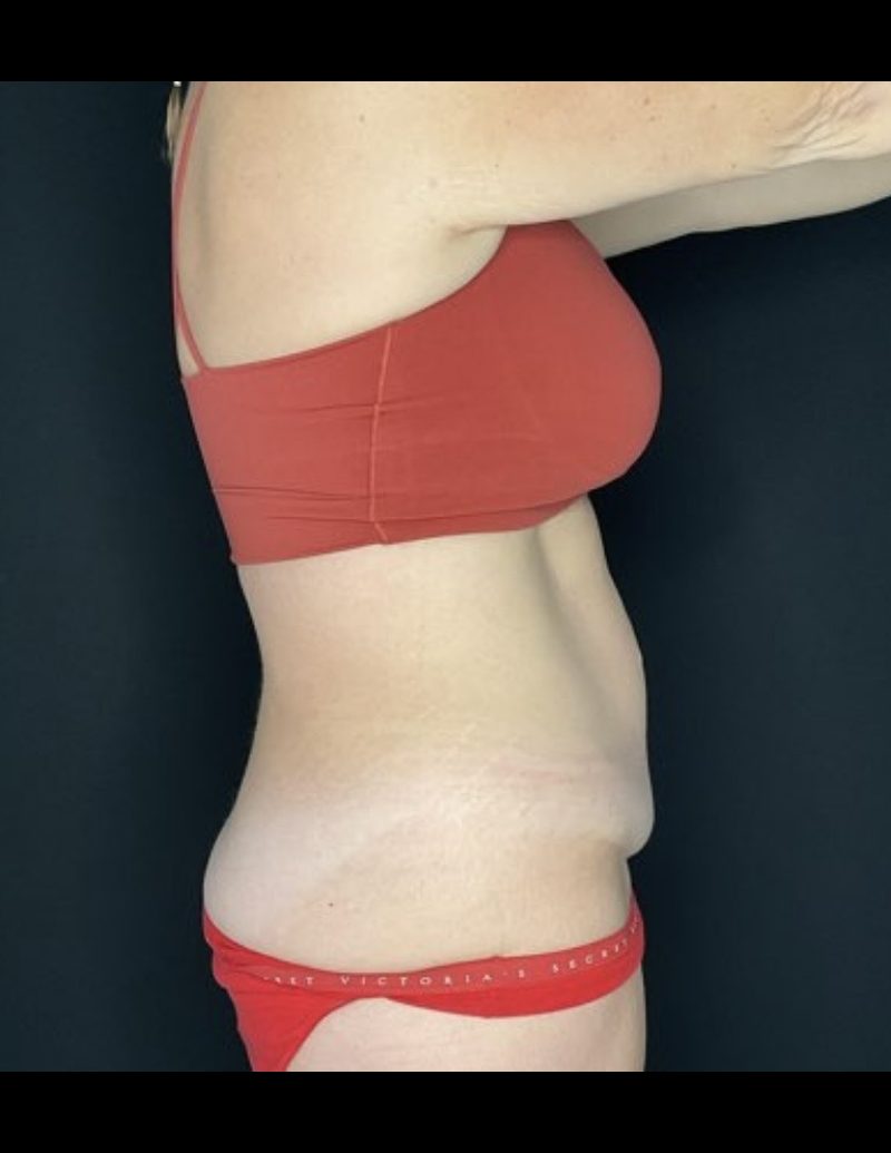 Tummy Tuck Patient Photo - Case 605 - before view-3