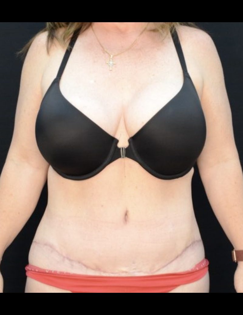 Tummy Tuck Patient Photo - Case 605 - after view