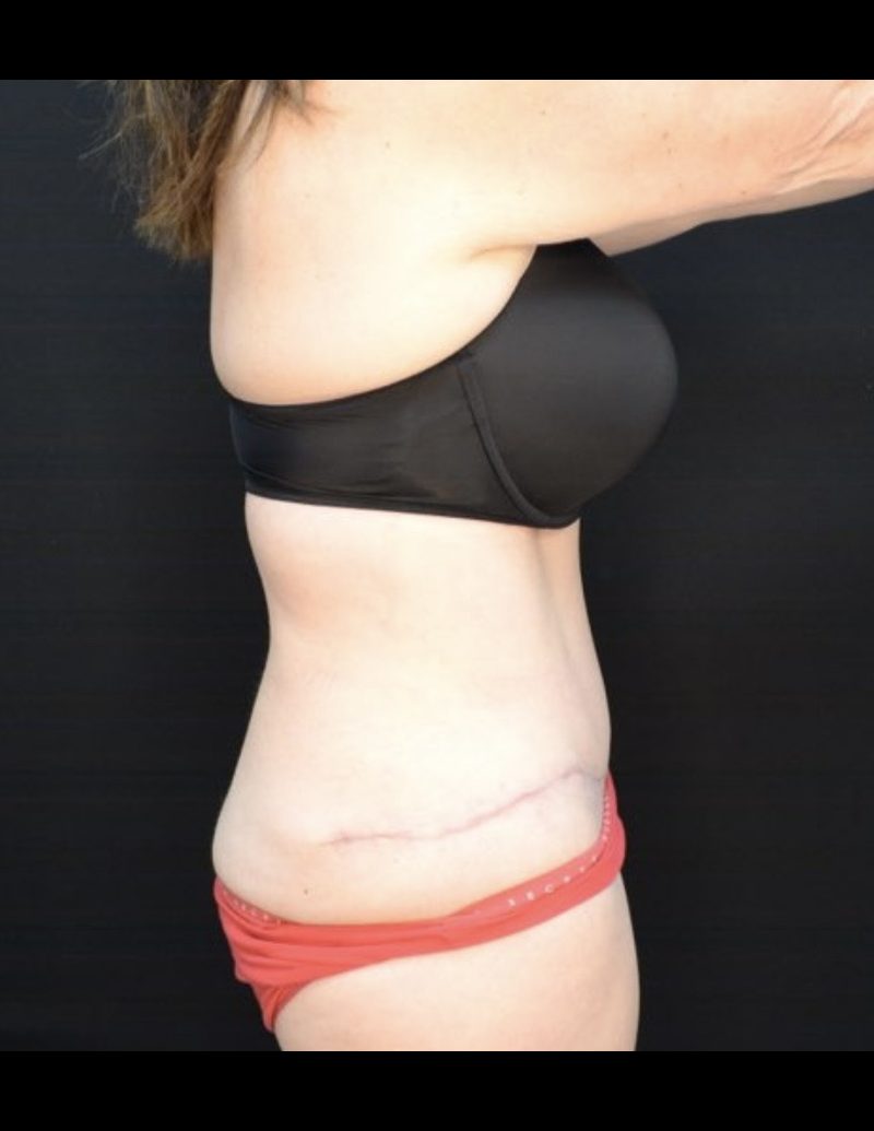 Tummy Tuck Patient Photo - Case 605 - after view-3