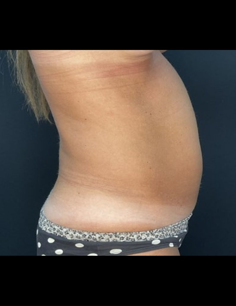 Liposuction Patient Photo - Case 606 - before view-2