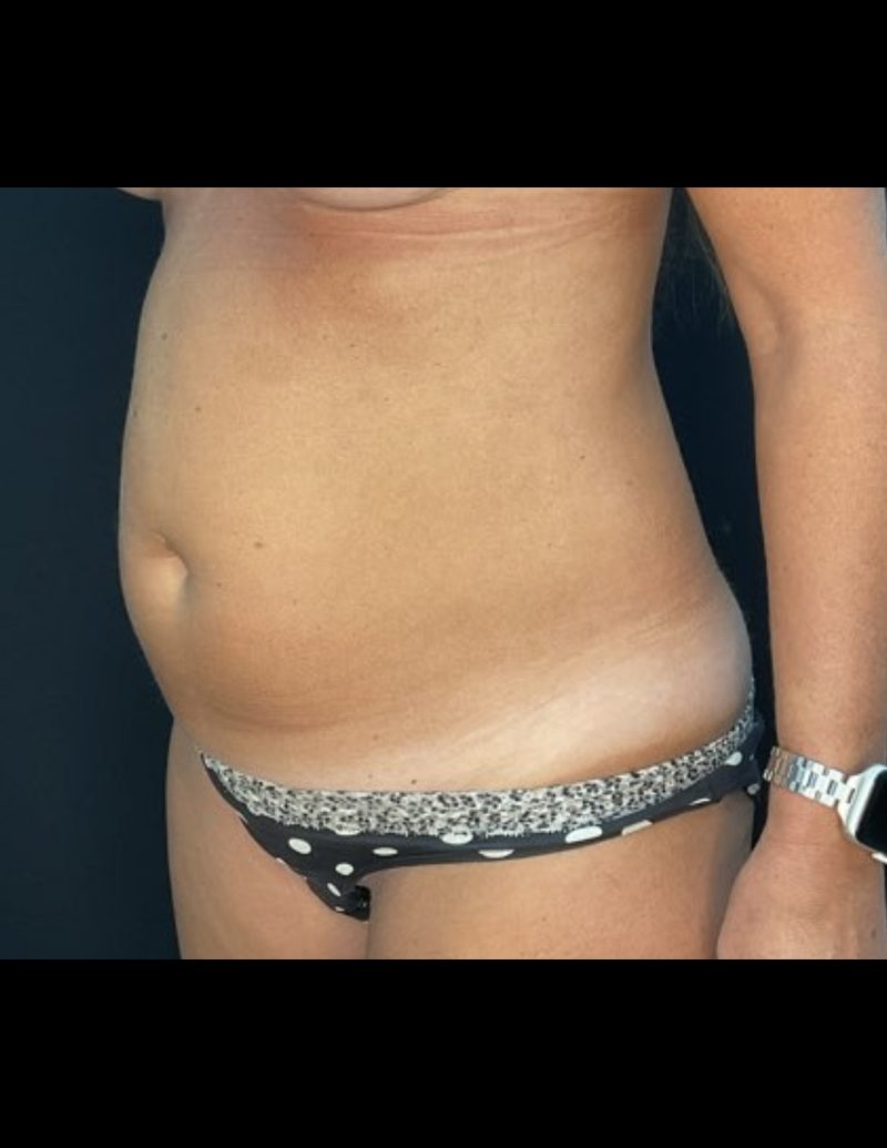 Liposuction Patient Photo - Case 606 - before view-3