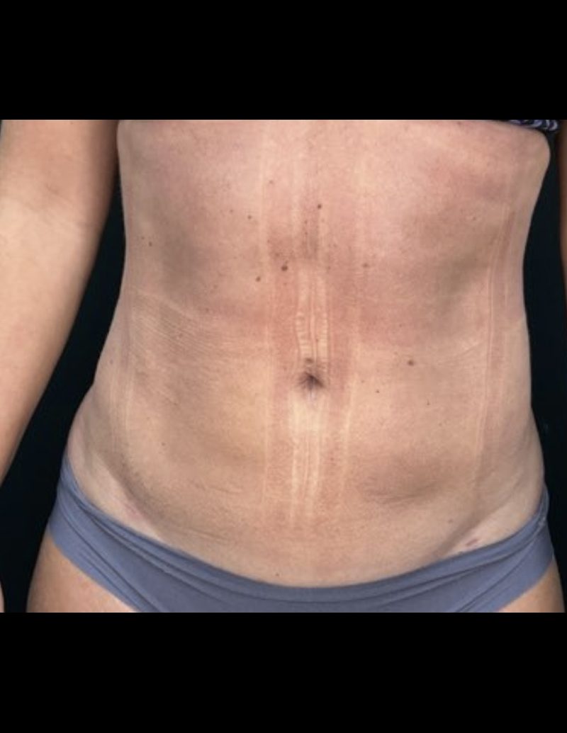 Liposuction Patient Photo - Case 606 - after view