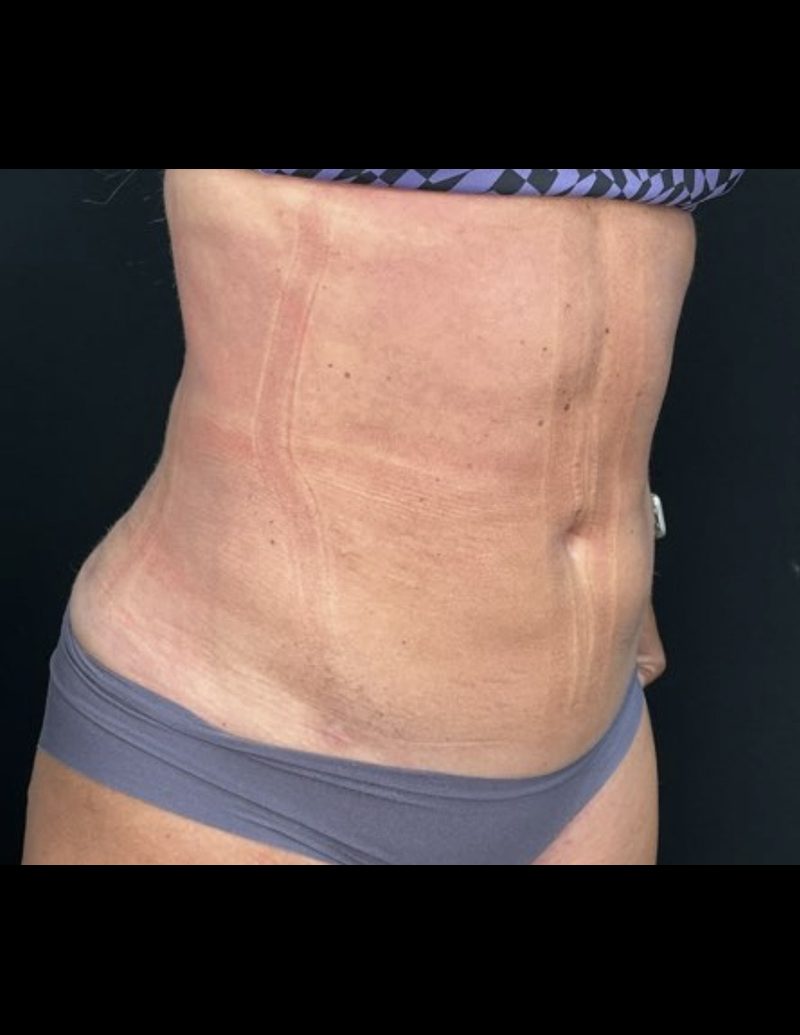 Liposuction Patient Photo - Case 606 - after view-1