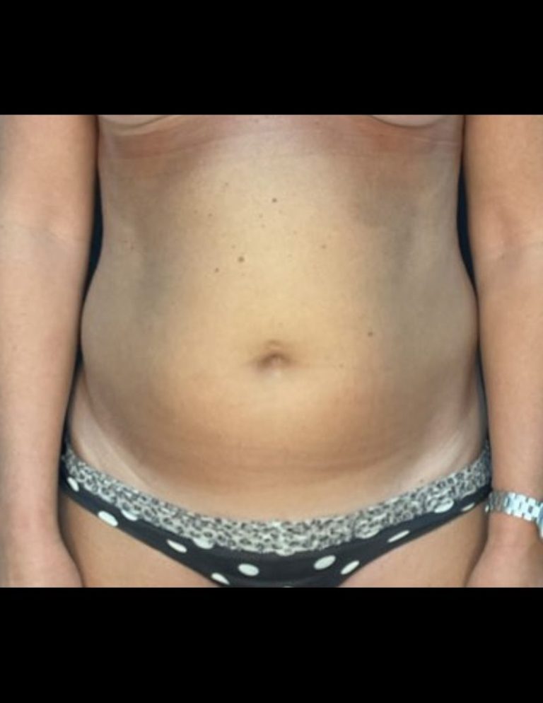 Liposuction - Case 606 - Before