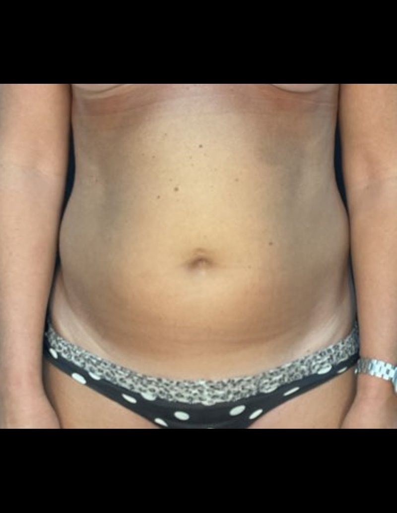Liposuction Patient Photo - Case 606 - before view-