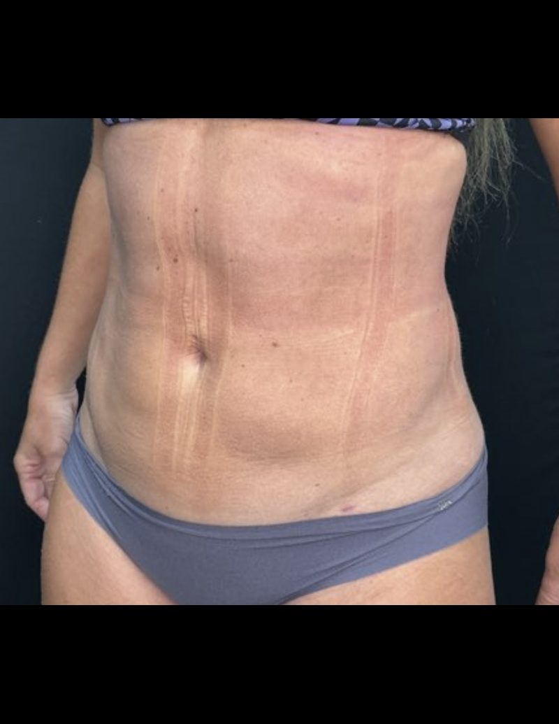 Liposuction Patient Photo - Case 606 - after view-3