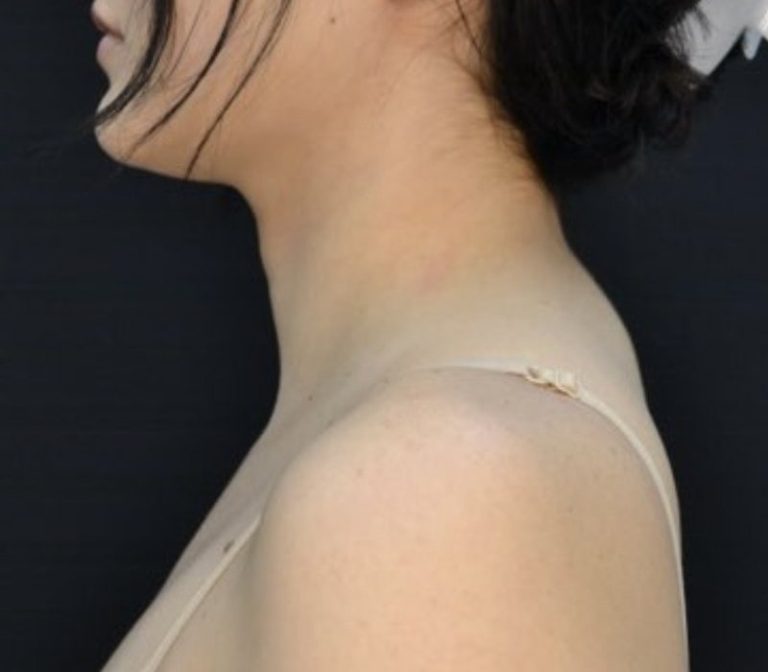 Liposuction - Case 612 - Before