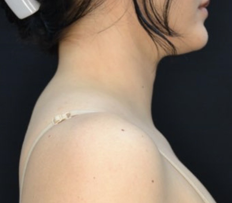 Liposuction Patient Photo - Case 612 - before view-1